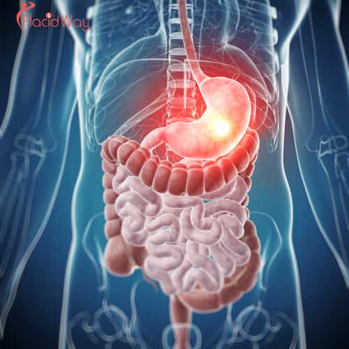 Alternative Stomach Cancer Treatment in Tijuana - Restoring Digestive Health